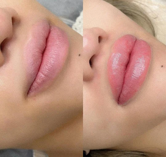 Renuka Krishna Lip Treatment